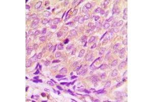 Immunohistochemical analysis of Histone Deacetylase 3 staining in human breast cancer formalin fixed paraffin embedded tissue section.