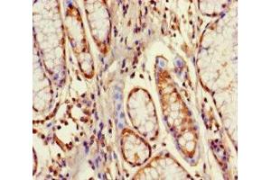 Immunohistochemistry of paraffin-embedded human gastric cancer using ABIN7164529 at dilution of 1:100 (GPX8 antibody  (AA 41-209))