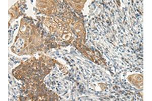 The image on the left is immunohistochemistry of paraffin-embedded Human cervical cancer tissue using ABIN7193020(VIPR2 Antibody) at dilution 1/35, on the right is treated with synthetic peptide. (VIPR2 antibody)