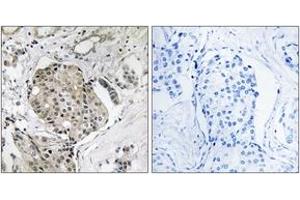 Immunohistochemistry analysis of paraffin-embedded human breast carcinoma, using USP40 Antibody.