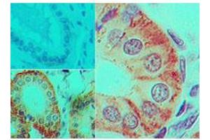 Immunohistochemistry of Mouse Anti-IL-17F antibody Tissue: human colon tissue Fixation: formalin-fixed, paraffin-embedded Primary antibody: isotype control (top left) , Mouse Anti-IL-17F antibody (bottom left, right) at 5 ug/ml (IL17F antibody)