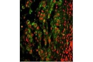 Immunofluorescence analysis of ITGAX Antibody (C-term) with paraffin-embedded human hepatocarcinoma. (CD11c antibody  (C-Term))