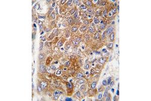 Formalin-fixed and paraffin-embedded human hepatocarcinoma tissue reacted with ALDH1L1 antibody (C-term), which was peroxidase-conjugated to the secondary antibody, followed by DAB staining. (ALDH1L1 antibody  (C-Term))