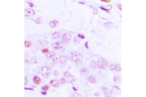 Immunohistochemical analysis of ATF2 (pT69) staining in human lung cancer formalin fixed paraffin embedded tissue section. (ATF2 antibody  (N-Term, pSer69))