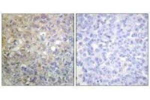Immunohistochemistry analysis of paraffin-embedded human breast carcinoma tissue using FGFR1 (Ab-766) antiobdy. (FGFR1 antibody  (Tyr766))