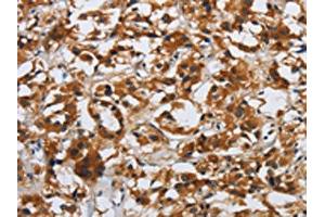 The image on the left is immunohistochemistry of paraffin-embedded Human thyroid cancer tissue using ABIN7190509(DSP Antibody) at dilution 1/40, on the right is treated with synthetic peptide. (Desmoplakin antibody)