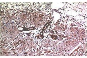 Immunohistochemistry of paraffin-embedded Human colon carcinoma tissue using MMP2 Monoclonal Antibody at dilution of 1:200. (MMP2 antibody)
