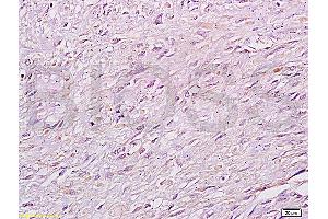 Formalin-fixed and paraffin: human cervical carcinoma labeled with Anti-RB1CC1 Polyclonal Antibody (ABIN872758), Unconjugated at 1:200 followed by conjugation to the secondary antibody and DAB staining (FIP200 antibody  (AA 501-600))