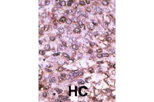 Formalin-fixed and paraffin-embedded human hepatocellular carcinoma tissue reacted with MAGEL2 polyclonal antibody  , which was peroxidase-conjugated to the secondary antibody, followed by DAB staining. (MAGE-Like 2 antibody  (C-Term))