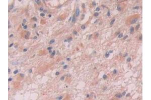 DAB staining on IHC-P; Samples: Human Glioma Tissue (Anion/Sugar Transporter antibody  (AA 146-405))