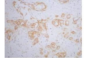 Immunohistochemistry (IHC) staining of Human Breast cancer tissue, diluted at 1:200. (beta Catenin antibody)