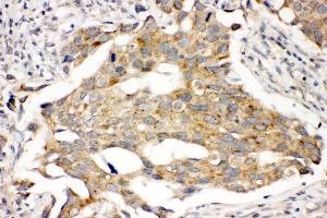 Anti-Prolactin Receptor antibody, IHC(P) IHC(P): Human Mammary Cancer Tissue (Prolactin Receptor antibody  (C-Term))