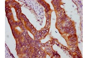 IHC image of ABIN7157699 diluted at 1:600 and staining in paraffin-embedded human colon cancer performed on a Leica BondTM system. (KRIT1 antibody  (AA 471-585))