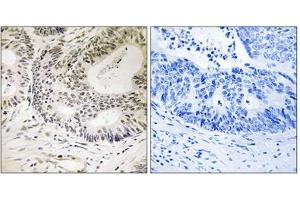 Immunohistochemical staining of paraffin-embedded human colon carcinoma tissue reacted with TP53BP1 (phospho S25) polyclonal antibody  at 1:50-1:100 dilution. (TP53BP1 antibody  (pSer25))