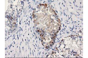 Immunohistochemical staining of paraffin-embedded Adenocarcinoma of Human ovary tissue using anti-MGLL mouse monoclonal antibody. (MGLL antibody)