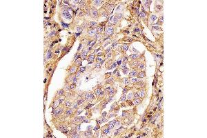 Paraformaldehyde-fixed, paraffin embedded Human lung adenocarcinoma section, Antigen retrieval by boiling in sodium citrate buffer (pH6. (CD44 antibody)