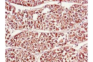 Immunohistochemistry of paraffin-embedded human liver cancer using ABIN7165275 at dilution of 1:100 (PDIA4 antibody  (AA 101-400))