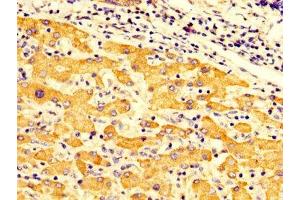 IHC image of ABIN7149956 diluted at 1:300 and staining in paraffin-embedded human liver cancer performed on a Leica BondTM system. (FMO3 antibody  (AA 111-219))