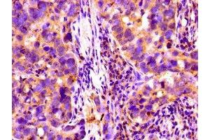 Immunohistochemistry of paraffin-embedded human pancreatic cancer using ABIN7148403 at dilution of 1:100 (Complement Factor I antibody  (AA 239-316))
