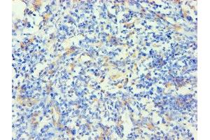 Immunohistochemistry of paraffin-embedded human cervical cancer using ABIN7157384 at dilution of 1:100 (KRT14 antibody  (AA 1-472))