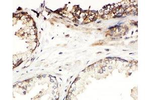 IHC-P: Kallikrein-11 antibody testing of human prostatic cancer tissue