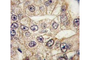 IHC analysis of FFPE human lung carcinoma tissue stained with CD14 antibody (CD14 antibody  (AA 54-83))
