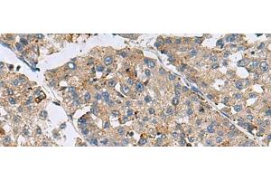 Immunohistochemistry of paraffin-embedded Human liver cancer tissue using MED31 Polyclonal Antibody at dilution of 1:100(x200) (MED31 antibody)
