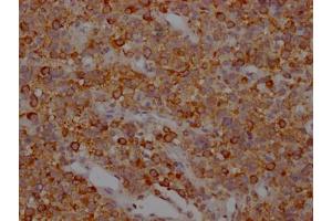 IHC image of ABIN7127835 diluted at 1:100 and staining in paraffin-embedded human glioma cancer performed on a Leica BondTM system. (Recombinant MAPT antibody)