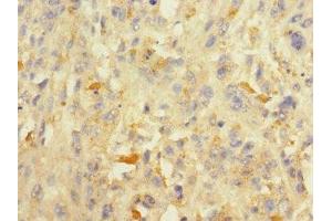 Immunohistochemistry of paraffin-embedded human melanoma using ABIN7150058 at dilution of 1:100