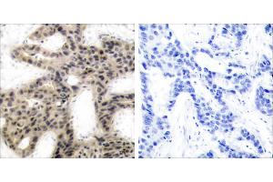 P-Peptide - +Immunohistochemical analysis of paraffin-embedded human breast carcinoma tissue using 4E-BP1 (phospho-Thr45) antibody. (eIF4EBP1 antibody  (pThr45))
