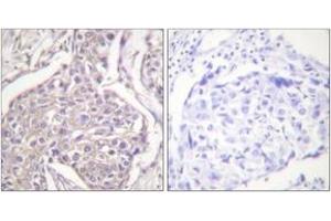 Immunohistochemistry analysis of paraffin-embedded human breast carcinoma, using HSP20 (Phospho-Ser16) Antibody. (HSPB6 antibody  (pSer16))