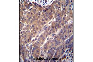 ARL2 Antibody (C-term) (ABIN650704 and ABIN2839229) immunohistochemistry analysis in formalin fixed and paraffin embedded human hepatocarcinoma followed by peroxidase conjugation of the secondary antibody and DAB staining. (ARL2 antibody  (C-Term))