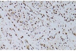 Immunohistochemistry of paraffin-embedded Human uterine cancer using HUS1 Polyclonal Antibody at dilution of 1:100 (40x lens). (HUS1 antibody)