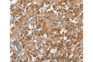 Immunohistochemistry of Human cervical cancer using CUL7 Polyclonal Antibody at dilution of 1:50 (Cullin 7 antibody)
