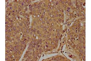 IHC image of ABIN7152998 diluted at 1:100 and staining in paraffin-embedded human liver cancer performed on a Leica BondTM system. (FLCN antibody  (AA 291-579))