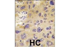 Formalin-fixed and paraffin-embedded human hepatocarcinoma tissue reacted with PFKFB1 antibody (N-term), which was peroxidase-conjugated to the secondary antibody, followed by DAB staining. (PFKFB1 antibody  (N-Term))