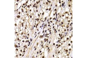 Immunohistochemistry of paraffin-embedded human kidney cancer using HIRIP3 antibody (ABIN5974221) at dilution of 1/100 (40x lens). (HIRIP3 antibody)