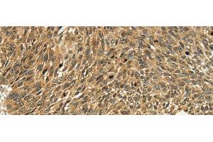 Immunohistochemistry of paraffin-embedded Human lung cancer tissue using PSMD10 Polyclonal Antibody at dilution 1:40 (PSMD10 antibody)