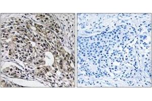 Immunohistochemistry analysis of paraffin-embedded human breast carcinoma tissue, using MRPL13 Antibody. (MRPL13 antibody  (AA 121-170))