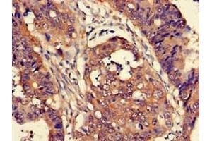 Immunohistochemistry of paraffin-embedded human colon cancer using ABIN7165226 at dilution of 1:100 (CUTA antibody  (AA 33-150))
