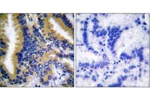 Immunohistochemistry analysis of paraffin-embedded human lung carcinoma tissue, using BIK (Ab-33) Antibody.
