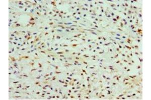 Immunohistochemistry of paraffin-embedded human breast cancer using ABIN7147984 at dilution of 1:100 (COTL1 antibody  (AA 1-142))