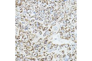 Immunohistochemistry of paraffin-embedded human esophageal cancer using VEGFB Rabbit pAb (ABIN6128909, ABIN6150090, ABIN6150092 and ABIN6216417) at dilution of 1:150 (40x lens). (VEGFB antibody  (AA 25-207))