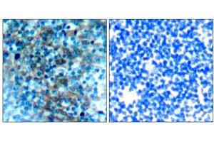 Immunohistochemical analysis of paraffin-embedded human tonsil carcinoma tissue, using VASP (Ab-238) antibody (E021172). (VASP antibody)