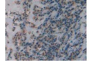 IHC-P analysis of Human Breast Cancer Tissue, with DAB staining. (DBH antibody  (AA 335-571))
