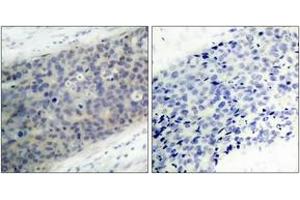 Immunohistochemistry analysis of paraffin-embedded human breast carcinoma, using LIMK2 (Phospho-Thr505) Antibody. (LIMK2 antibody  (pThr505))