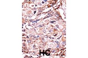 Formalin-fixed and paraffin-embedded human cancer tissue reacted with the primary antibody, which was peroxidase-conjugated to the secondary antibody, followed by AEC staining. (SMAD3 antibody  (pSer213))