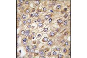 Formalin-fixed and paraffin-embedded human hepatocarcinoma tissue reacted with CLDN2 (Human N-term), which was peroxidase-conjugated to the secondary antibody, followed by DAB staining. (Claudin 2 antibody  (N-Term))
