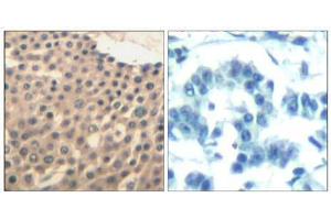 Immunohistochemical analysis of paraffin-embedded human lung carcinoma tissue using HDAC4/HDAC5/HDAC9 (Ab-246/259/220) Antibody (E021517). (HDAC4/HDAC5/HDAC9 antibody)