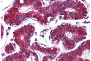 Human Breast (formalin-fixed, paraffin-embedded) stained with PDCD4 antibody ABIN213965 at 5 ug/ml followed by biotinylated goat anti-rabbit IgG secondary antibody ABIN481713, alkaline phosphatase-streptavidin and chromogen. (PDCD4 antibody  (C-Term))